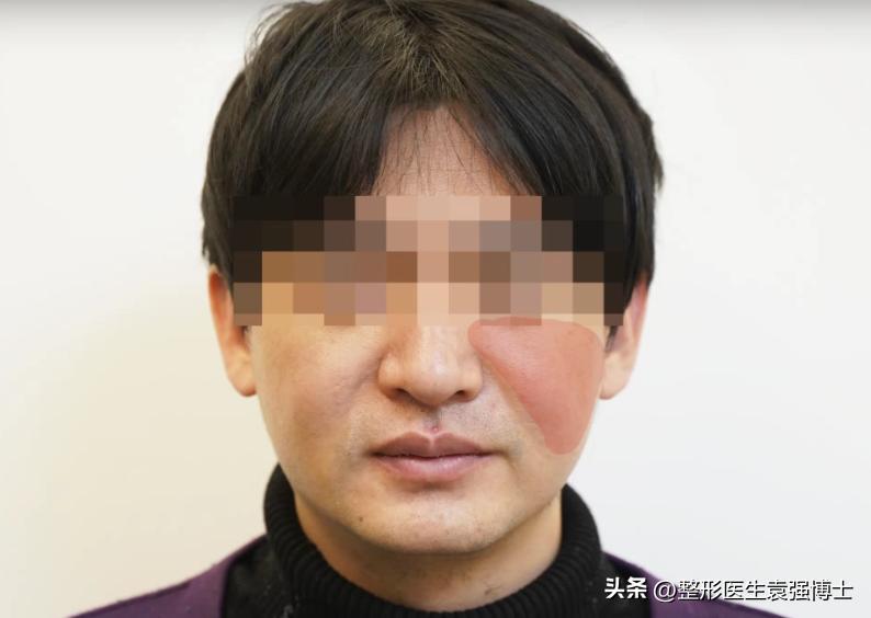 38岁小伙挑战全脸拉皮,术后逆袭帅气小哥,身边朋友不敢认