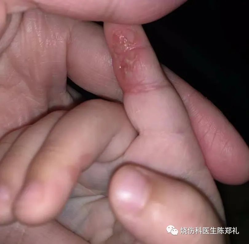 放烟花伤了人怎么办,鞭炮炸伤面部轻微怎么处理不留疤