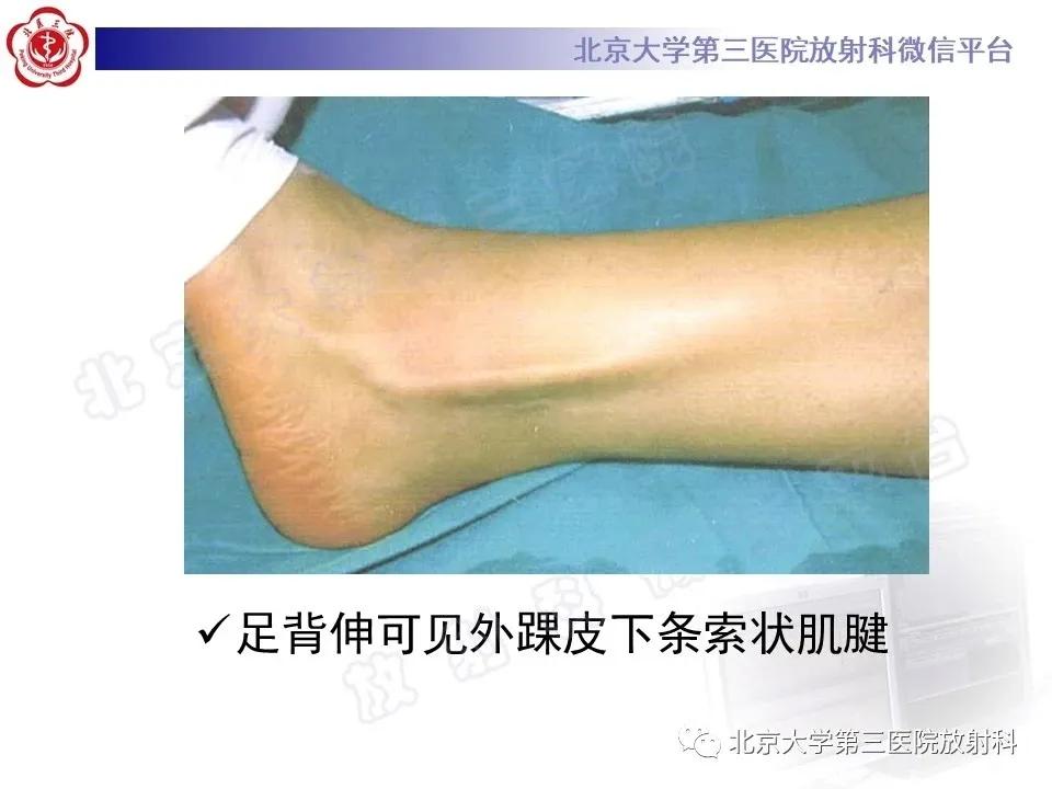 好文分享续集,腓骨肌腱脱位手术价格