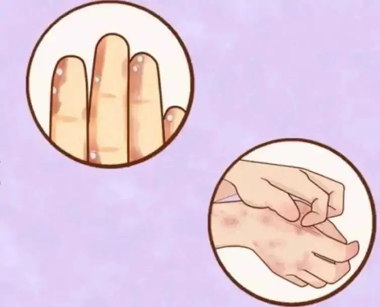 手癣和手部皲裂性湿疹的区别,手部湿疹和手癣的鉴别点主要为