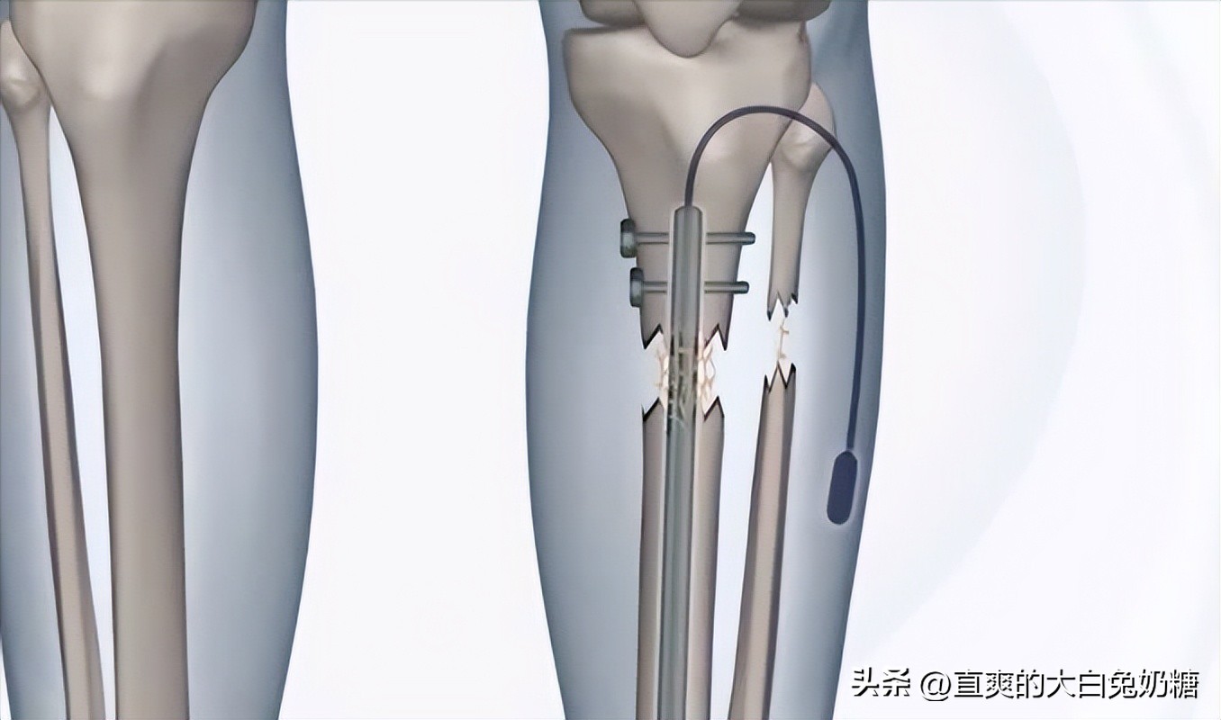 李亚诺断骨增高怎样了,断骨增高手术的李亚诺现状