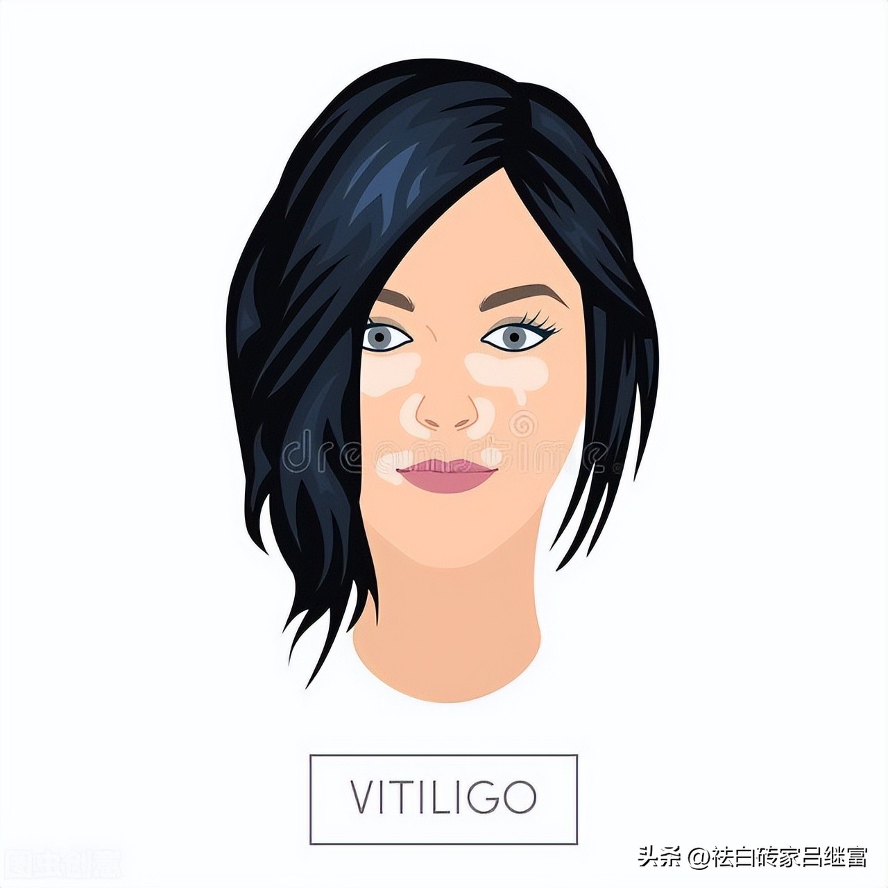 快速区分白癜风和无色素痣,早期白癜风是色素减退吗