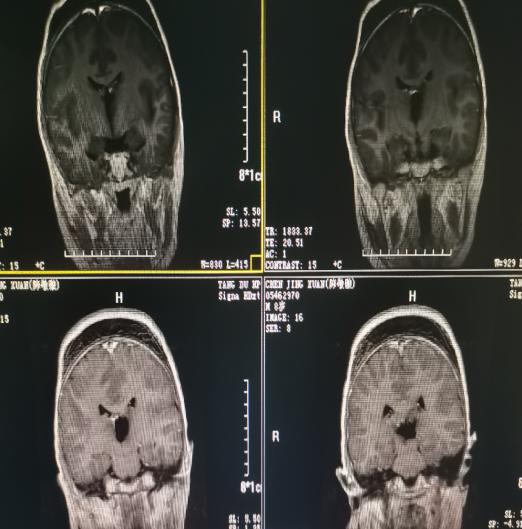 七岁男孩新长出的牙齿都有锯齿,7岁男孩朝上长一颗牙