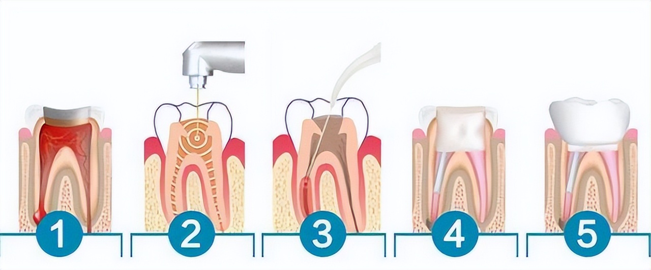 为什么根管治疗要戴牙冠,为什么根管治疗后要戴牙套