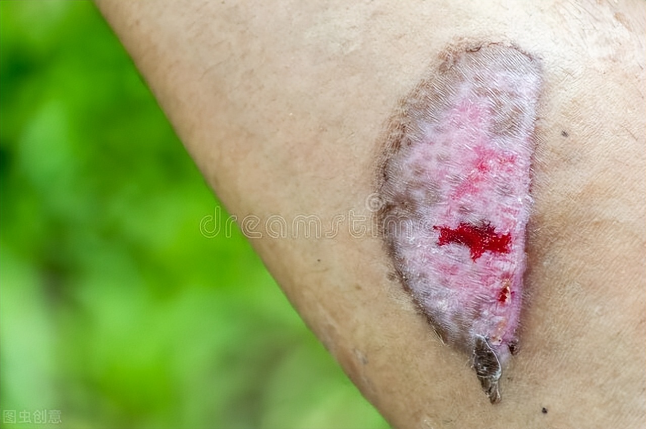 祛疤膏需要多长时间才能祛除疤痕,祛疤最佳治疗期