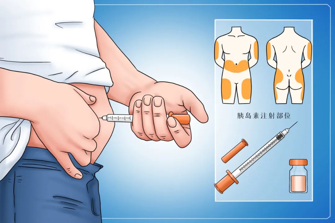 糖尿病初期用胰岛素强化治疗好吗,短期强化胰岛素治疗方案