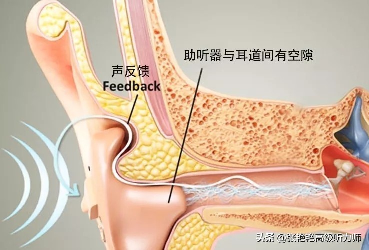 为什么戴上助听器感觉很吵,助听器为什么戴着好吵