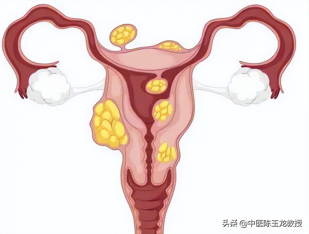 身体里湿气特别重痰多喝姜汤好吗,喉咙痰多是不是湿气重