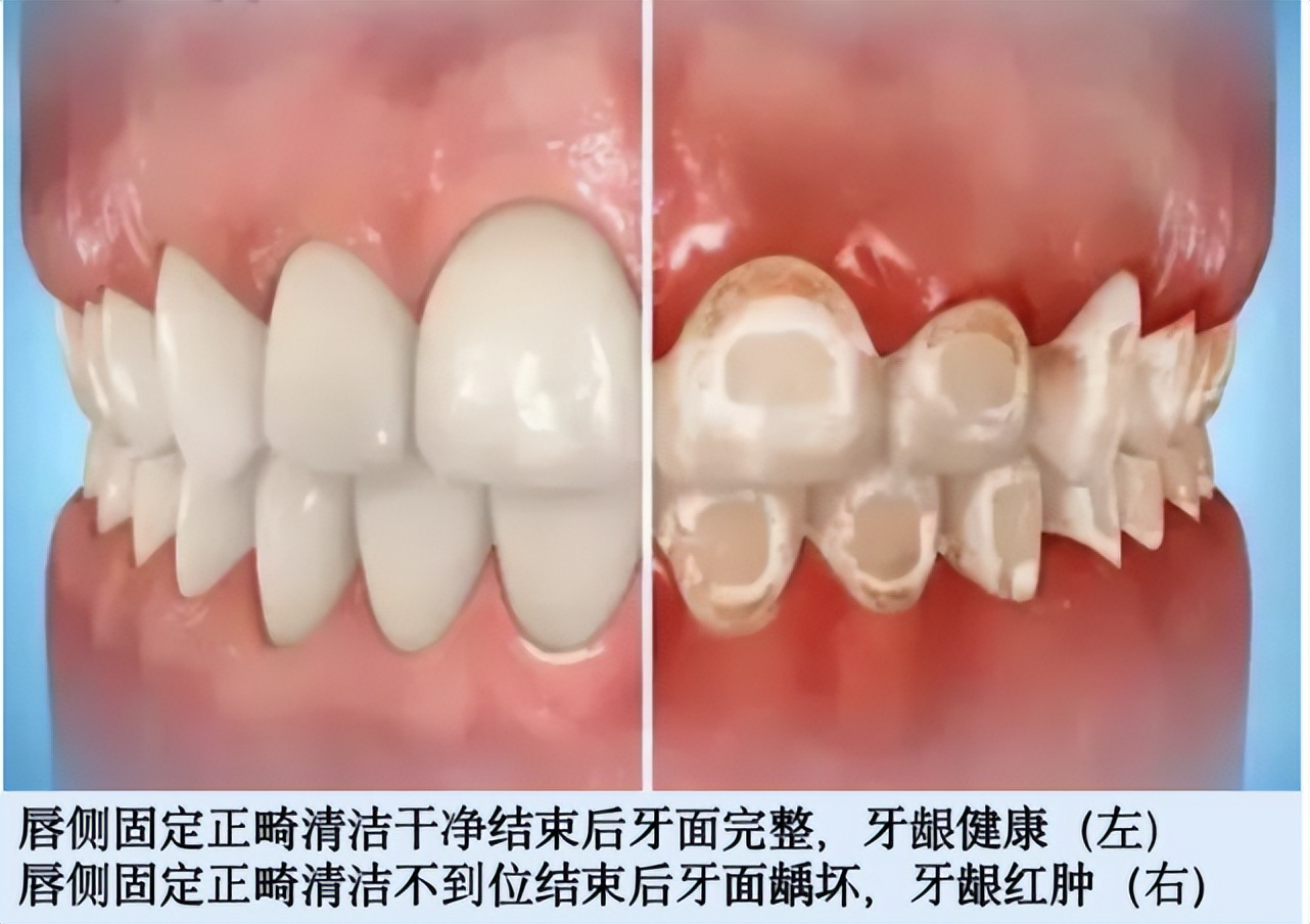 隐形牙套让一颗牙齿变高,隐形牙套让你在不知不觉中变美