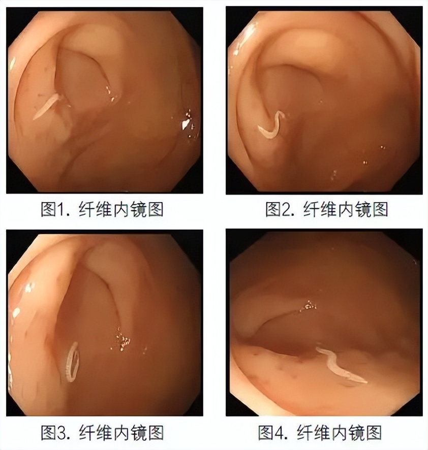 22岁少女体内有寄生虫,20岁女孩腹部有寄生虫