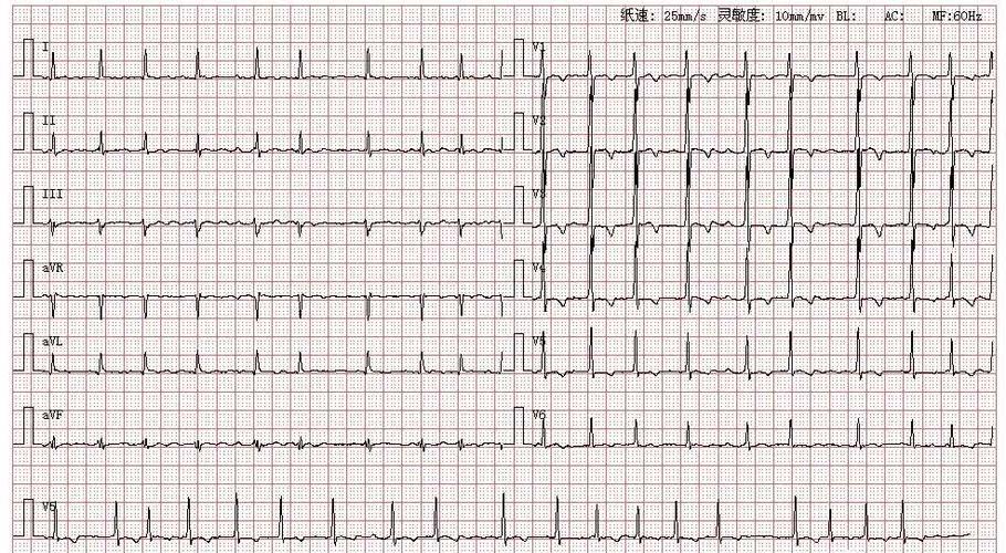 治疗阵发性房颤,阵发性房颤与持续性房颤治疗区别