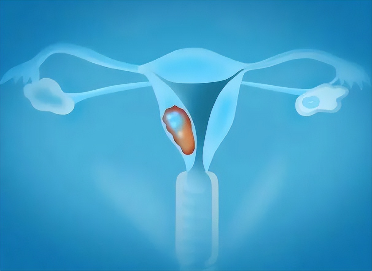 “外阴癌”是拖出来的吗？医生：出现5种异常信号，要引起注意