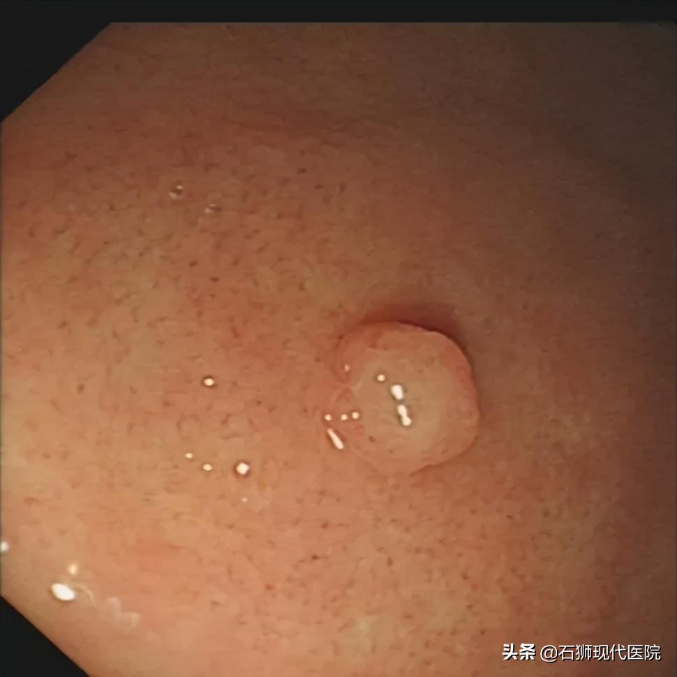 石狮医院有无痛胃镜吗,有哪些人不合适做胃镜