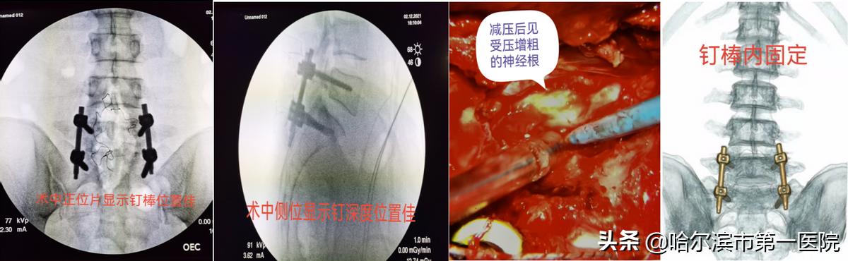 反复腰腿痛，去神经外科查查——哈市第一院神经外科成功完成首例腰椎峡部裂伴腰骶椎不稳术
