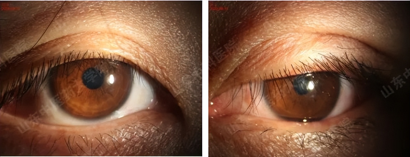 埋线双眼皮线头出来了严重吗,埋线双眼皮线头露在外边了怎么办