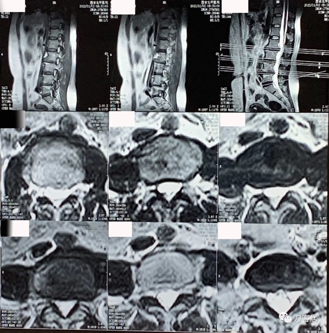 感染新冠左侧腰腹抽痛,腿酸疼是新型冠状病毒怎么治疗