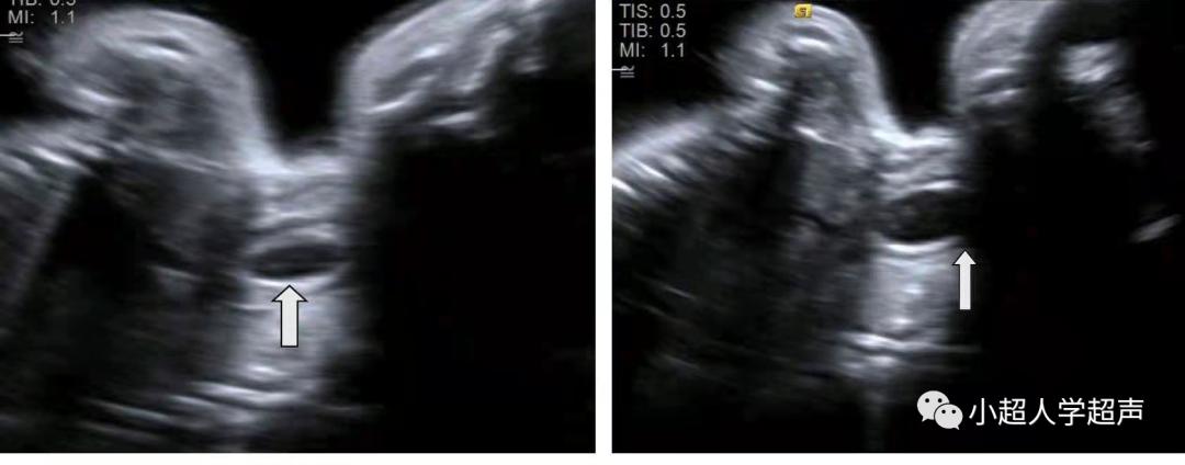 超声影像小视频,食道闭锁超声表现