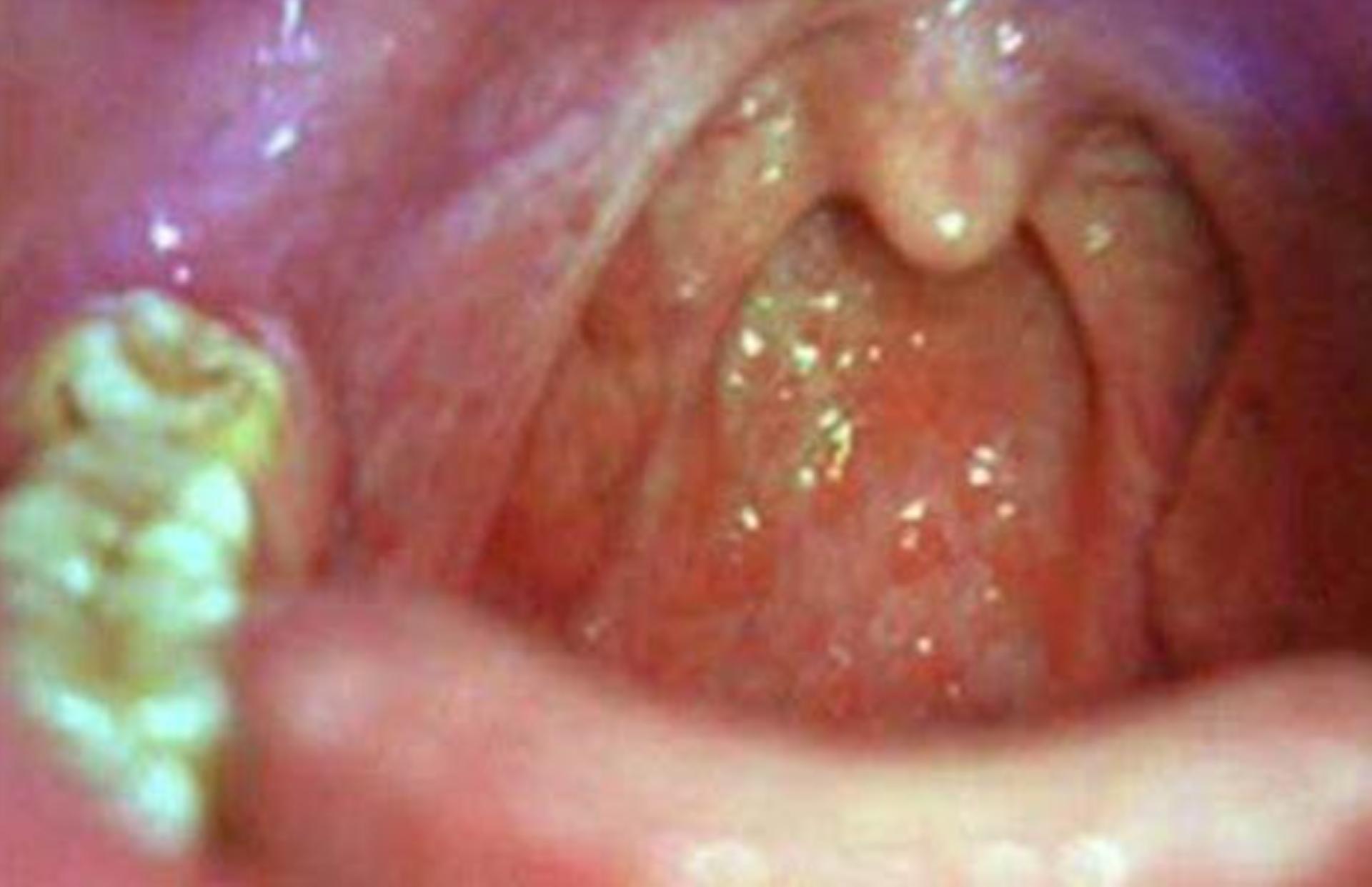 喉癌和鼻咽癌的发病率,与喉癌有关的因素