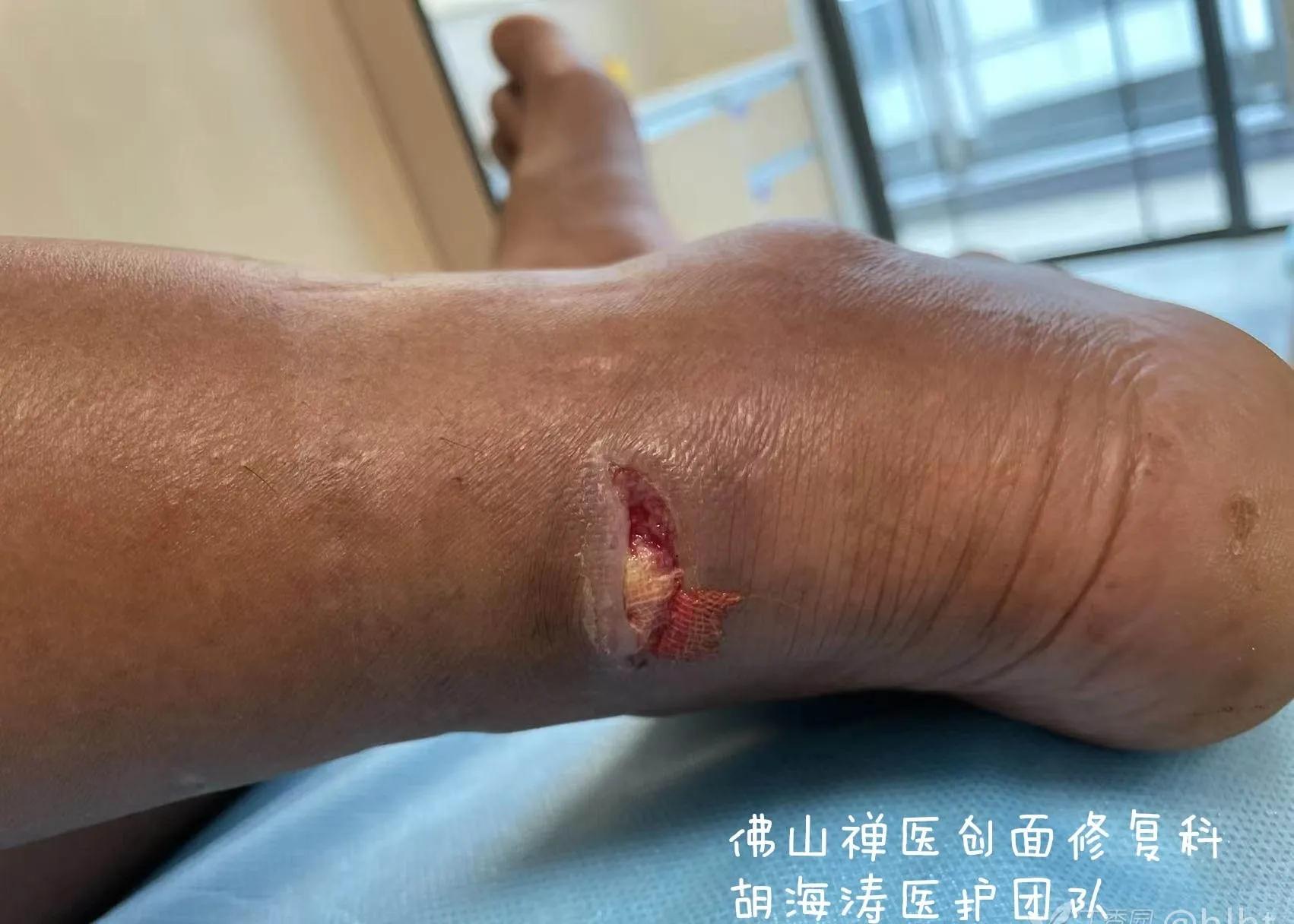 农民工受伤不去治疗,农民工受伤没去医院自己缝合伤口