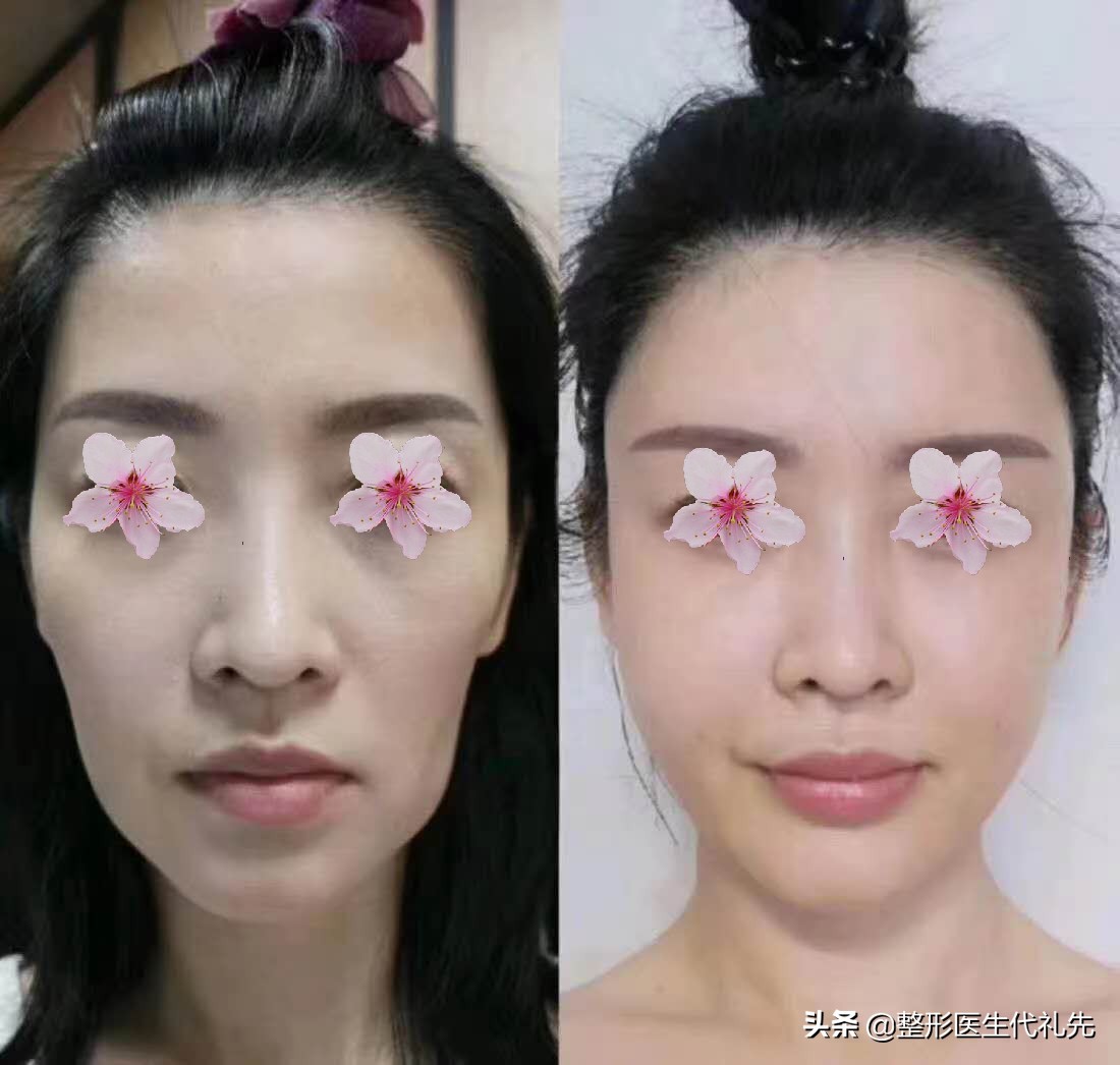 面部凹陷可以通过什么医美改善,面部整形面部凹陷怎么修复