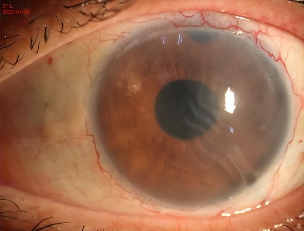 角膜失代偿移植角膜,角膜移植3个月了视力模糊重影