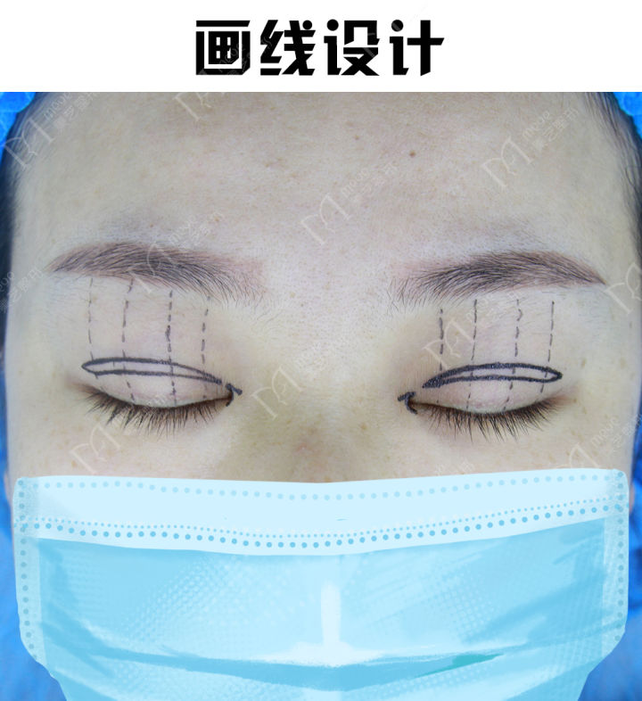 内双贴双眼皮贴可以变外双吗,双眼皮贴内双变外双