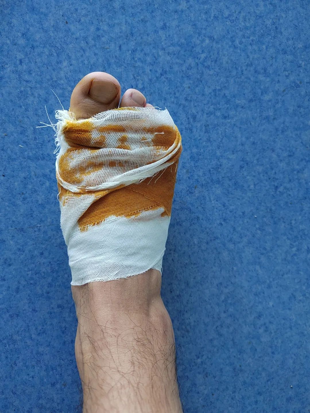 脚踩到钉子上怎么处理,脚踩到钉子处理视频