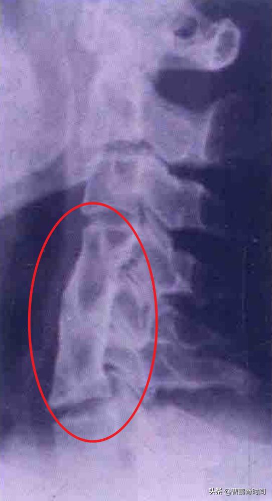 脖子两侧筋痛要警惕三种疾病,天生短脖子怎么改善