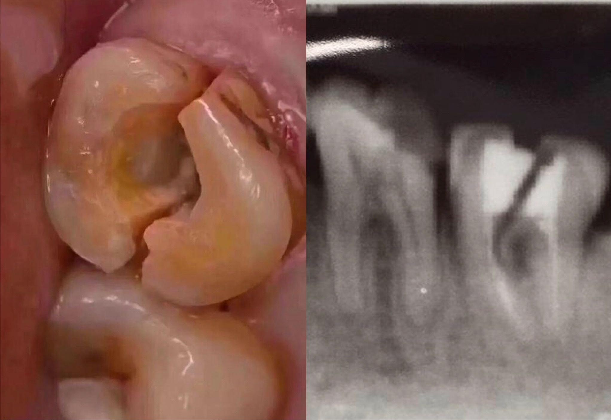 烂牙做根管治疗,烂牙做牙套好吗