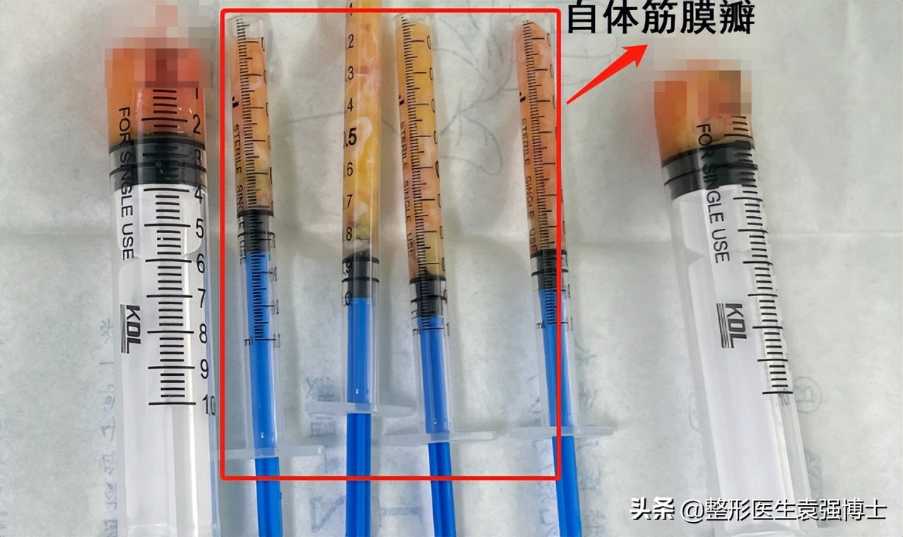 40岁去法令纹最好的方法,40岁就有很深的法令纹