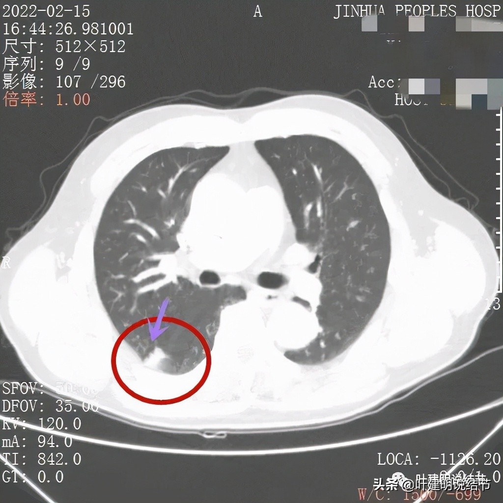 肺腺癌高危亚型什么意思,肺腺癌高危亚型