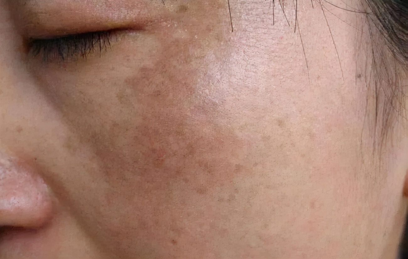 皮秒祛斑个人经历,轻医美祛斑怎么做的