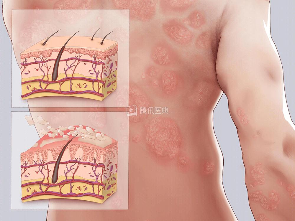 一睡醒，满床都是皮屑！“得了这病，剪发到一半就被赶出来”