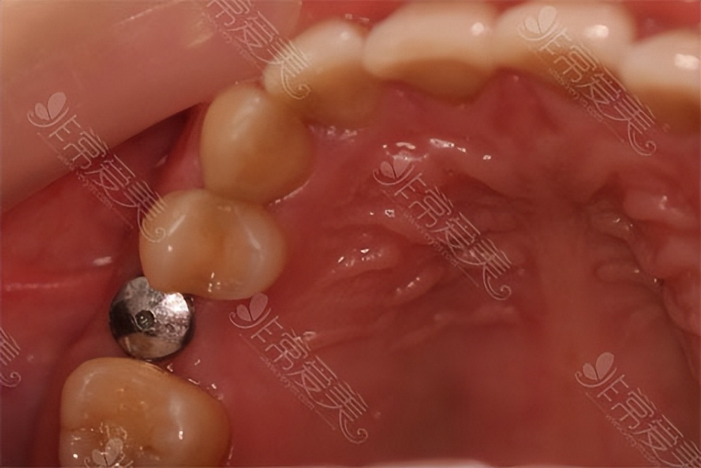 种植牙一颗多少元大概,种植牙究竟多少钱一颗