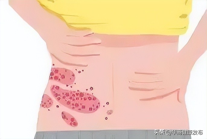 带状疱疹怎么办,孕妇得了带状疱疹怎么办