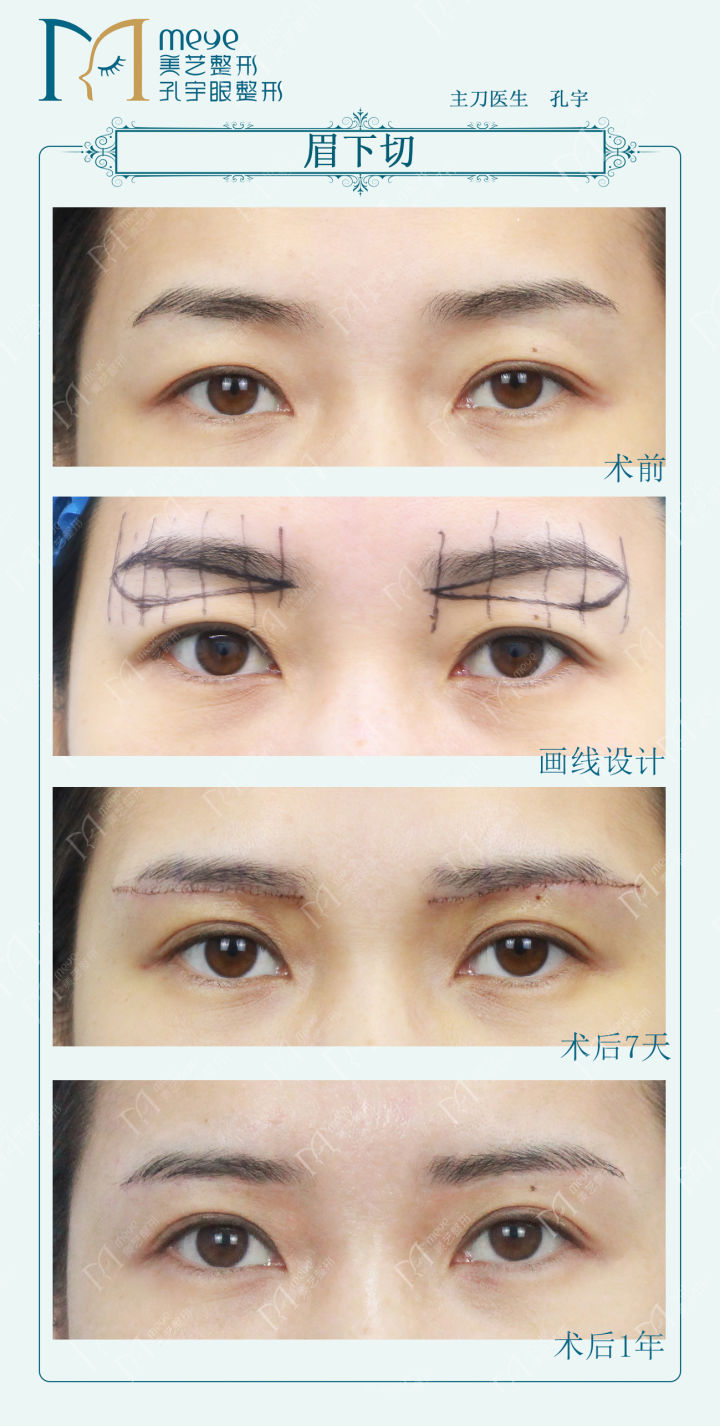 内双贴双眼皮贴可以变外双吗,双眼皮贴内双变外双