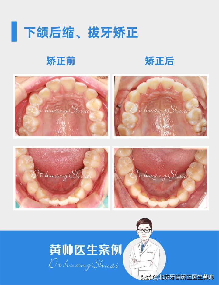 嘴凸的人怎么笑起来好看,嘴凸怎么让自己不焦虑