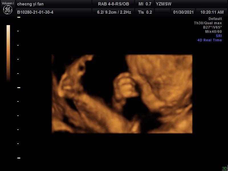 23周做了四维28周还需要再做吗,孕23周四维查出问题还能留吗