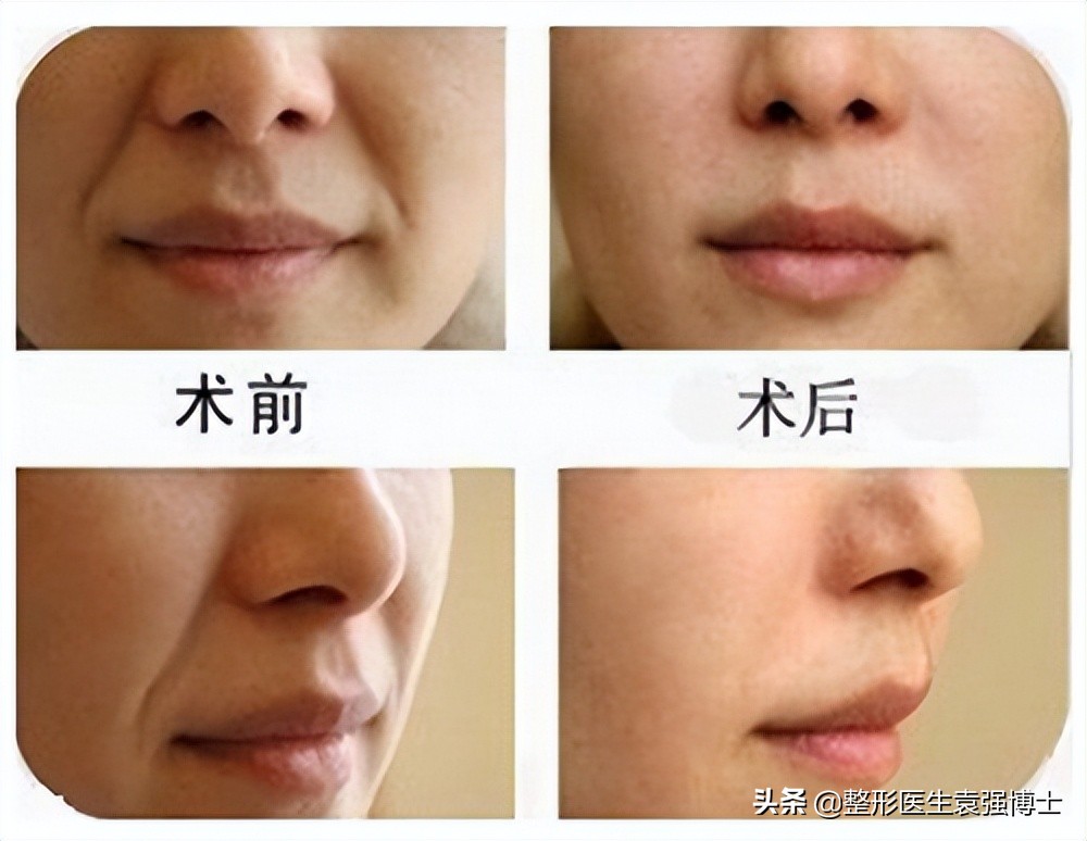 40岁就有很深的法令纹,40岁男士法令纹最新消除法