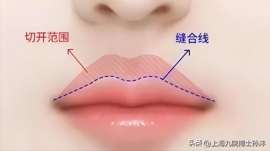 人中太长怎么缩短不留疤,人中长缩短术