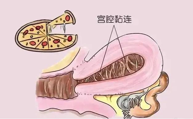 宫腔粘连是不是怀不上孩子,宫腔粘连一定是流产导致的吗