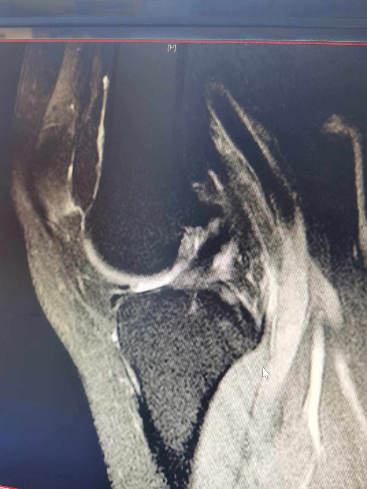 膝关节常见损伤场景和预防,常见的膝关节损伤及相关动作障碍