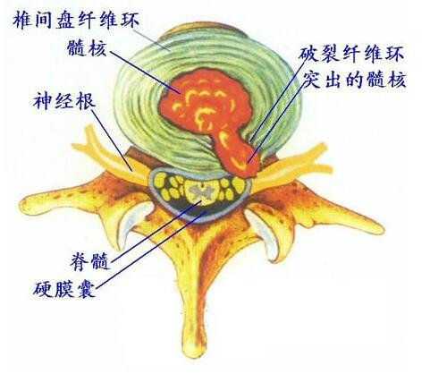 腰间盘突出没有有效的治疗方法,腰间盘突出想治好怎么治