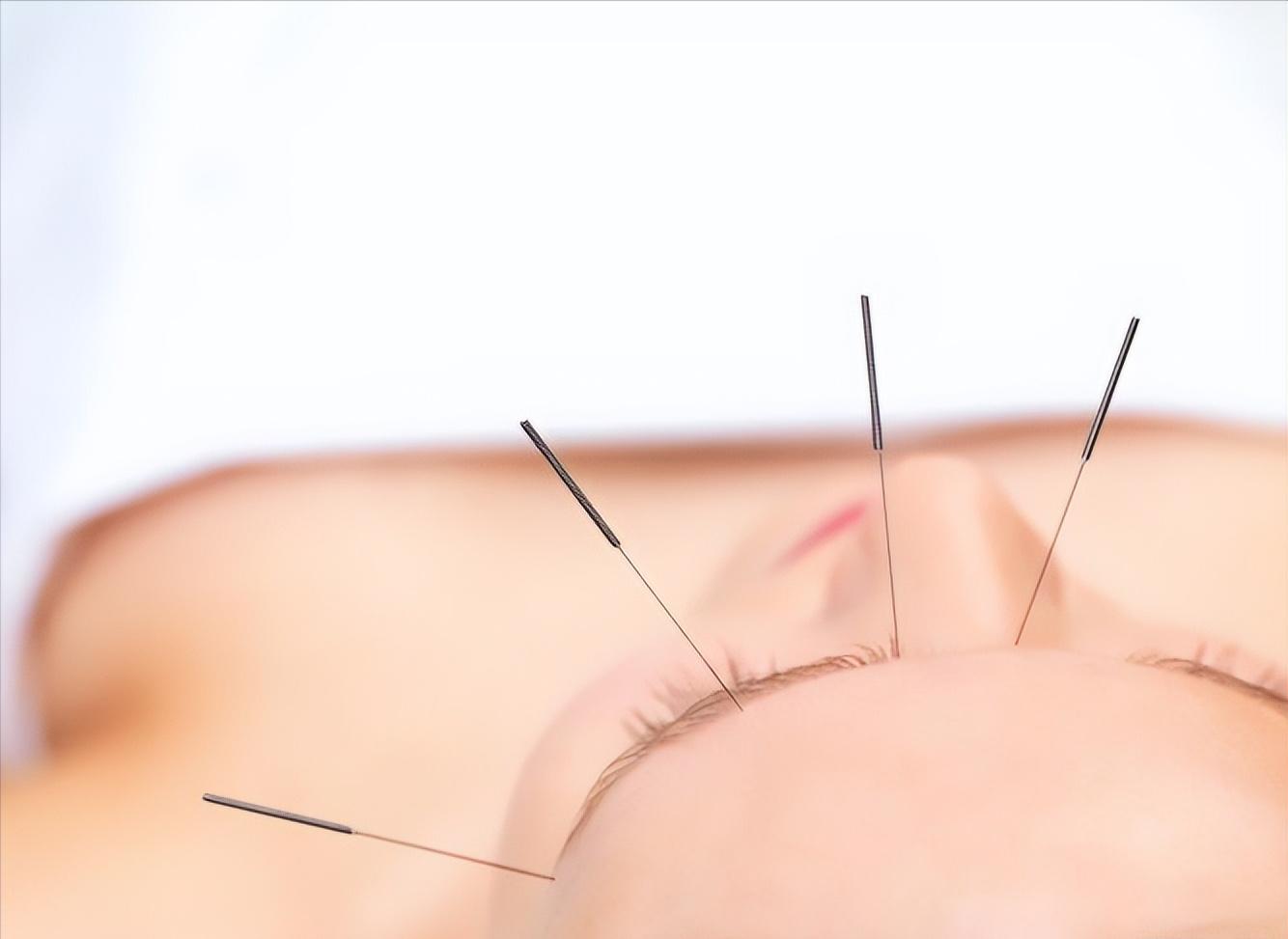 针灸临床经验选编精华,古法针灸临床治验