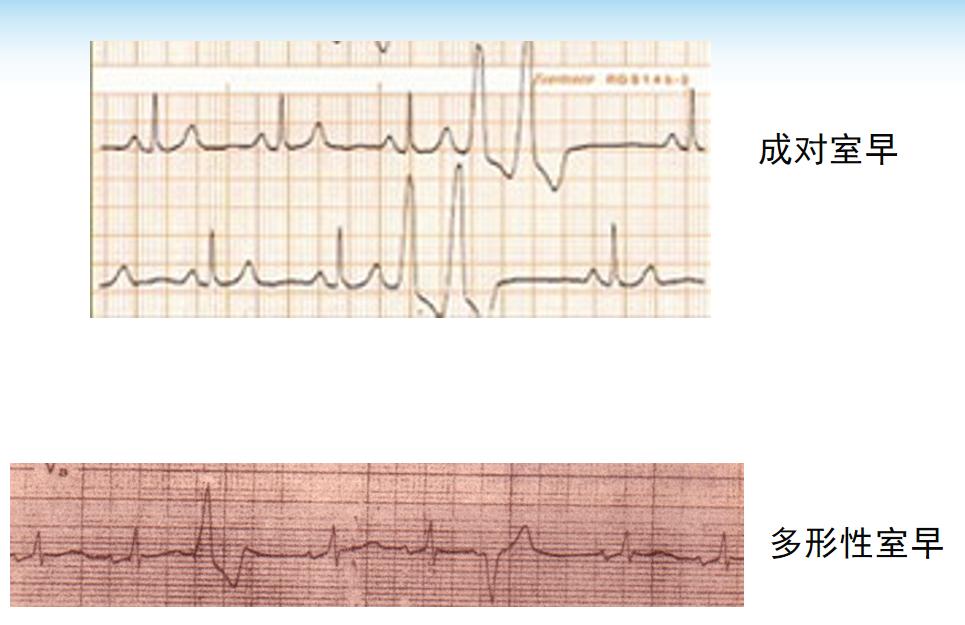 心律失常四型,心律失常四肢乏力胸口难受