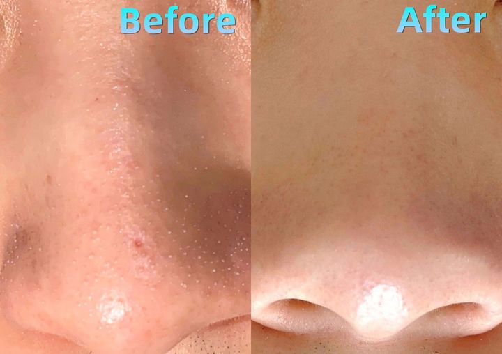 鼻子上的黑头会长毛么,鼻子上的黑头会蔓延到脸上吗