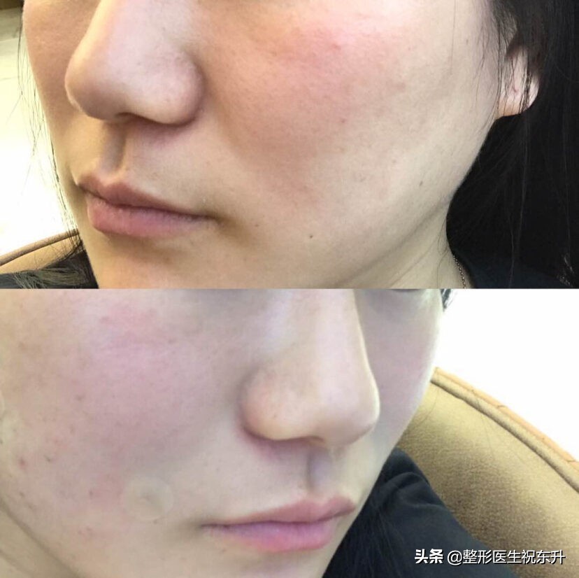 消除法令纹最有效的方法,脸上长法令纹怎么消除