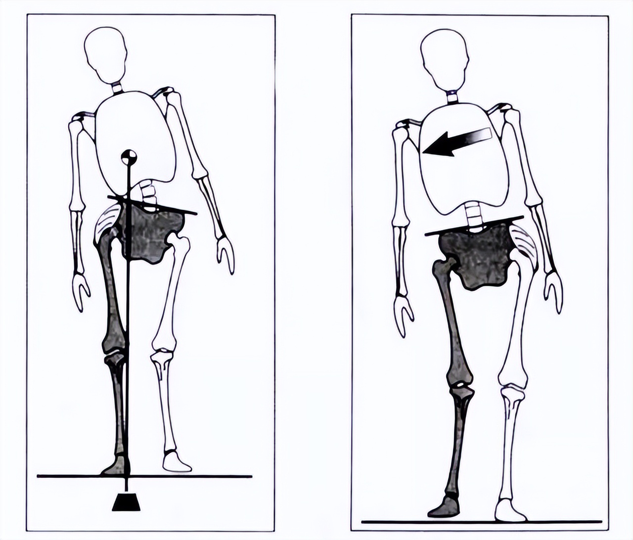 走路像鸭子是哪块肌肉的问题,走路像鸭子一样的是什么原因