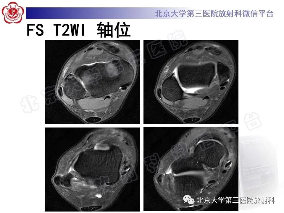 好文分享续集,腓骨肌腱脱位手术价格