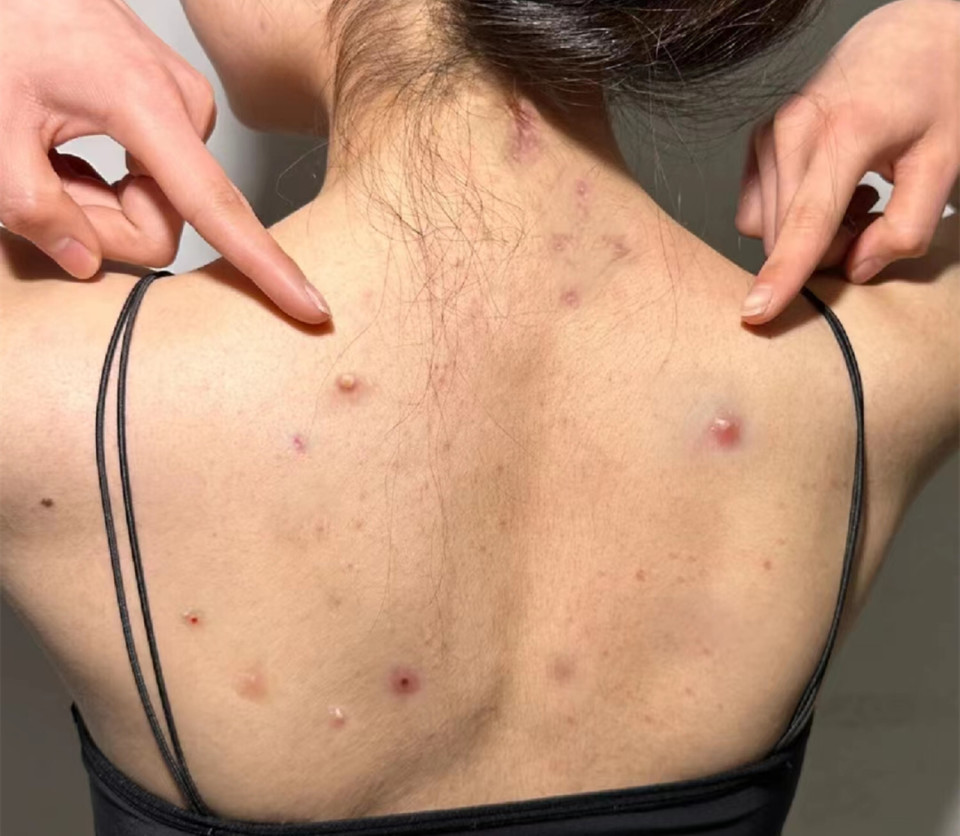 祛痘印沐浴露真实测评,沐浴露祛痘印持久留香